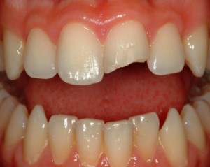 Corsco di ricostruzione denti