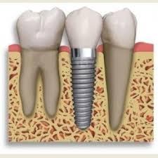 implantologia dentale a Messina