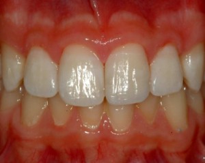 Dente ricostruito