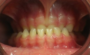 alterazioni sagittali con maggiore sviluppo della mandibola (malocclusioni di classe III) - Pre Terapia