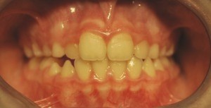 alterazioni sagittali con maggiore sviluppo della mandibola (malocclusioni di classe III) - Post Terapia