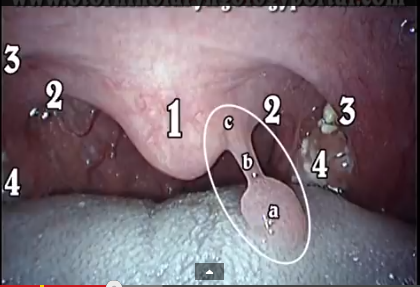 DM_il-dentista-moderno_hov-virus_papillomatosi_infezioni_condiloma-verruca-volgare- (1)
