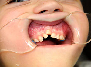 anchilosi-dentale