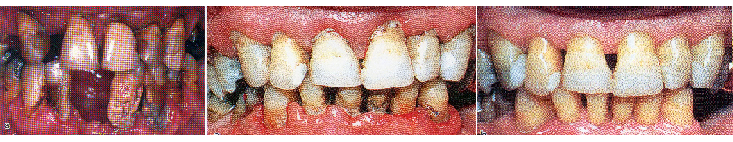 Parodontite grave		                        Parodontite		                Parodontite dopo terapia